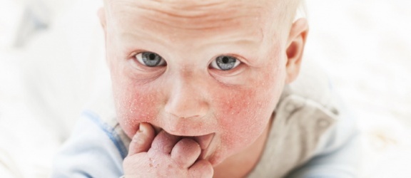 Gdy skóra swędzi i piecze, czyli atopowe zapalenie skóry u dziecka