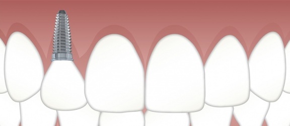 Implanty zębów - czy boli?